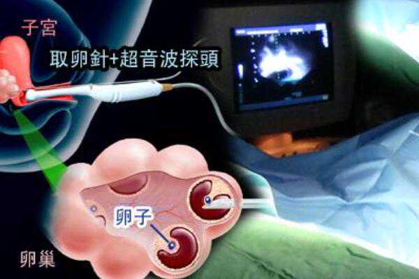 南京鼓楼做试管婴儿会挑人做吗？,南京多囊卵巢能怀上孩子吗